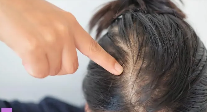 Stop Hair Fall for Female