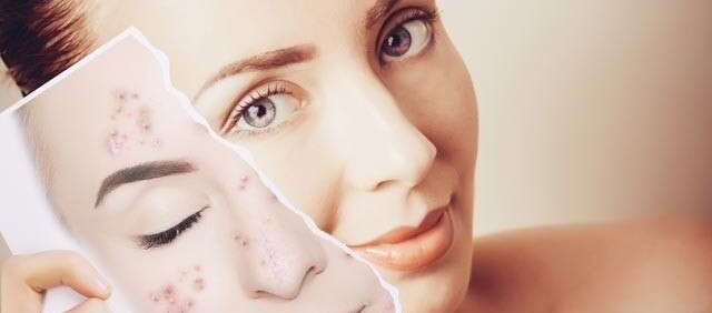 Remove Facial Blemishes Causes